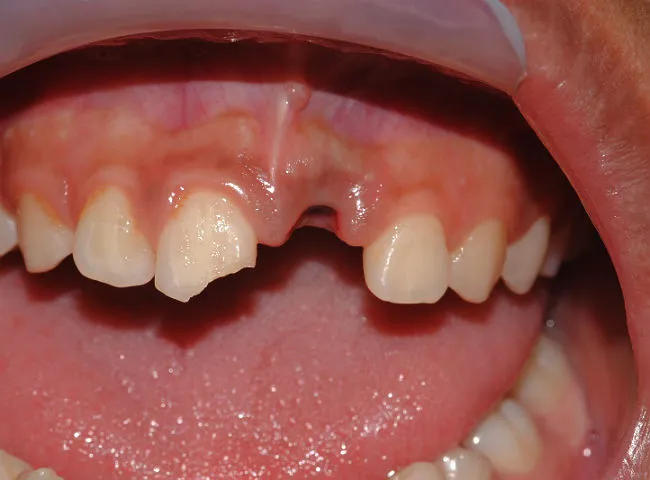 dente saiu