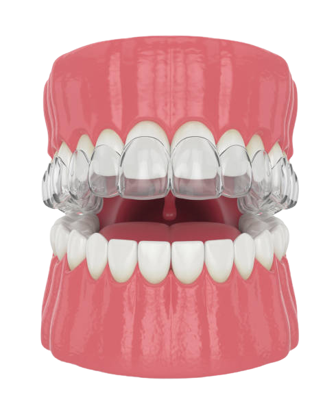 aparelho dentário invisível