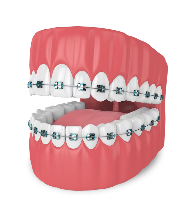 aparelho dentário fixo