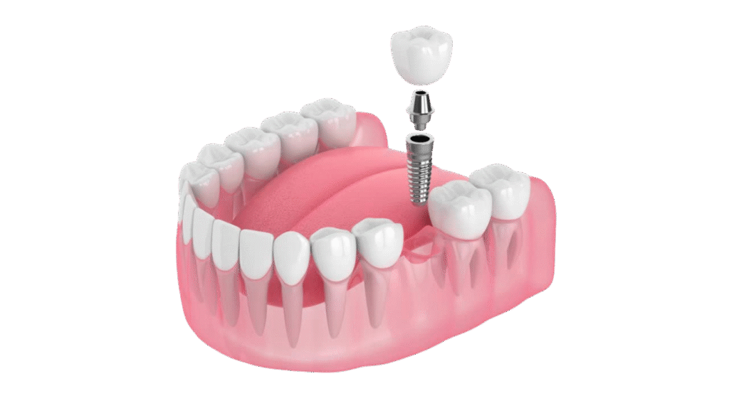 implantes dentários